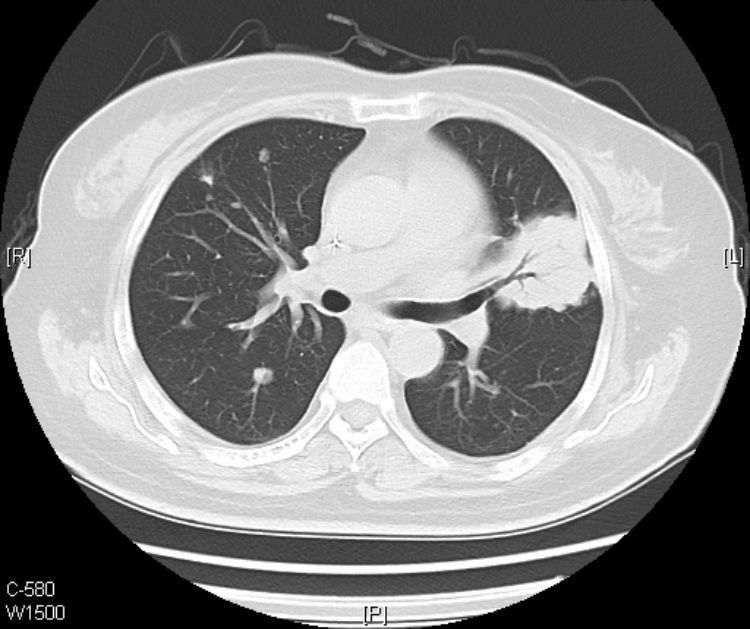 黏液腺癌基本不转移不复发,肺粘液腺癌转移了还能治好吗