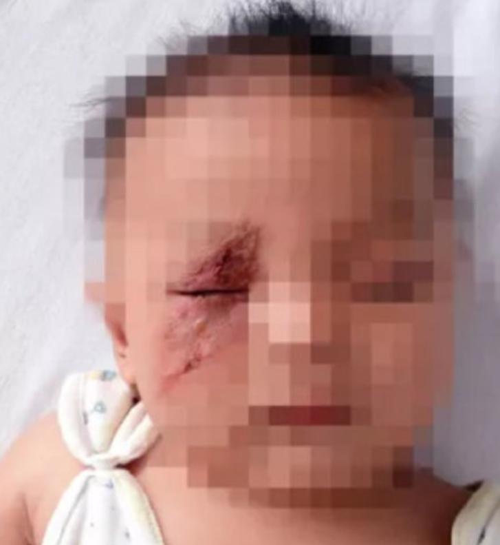 隐翅虫爬到脸上该怎么办,孩子被隐翅虫伤害了怎么办