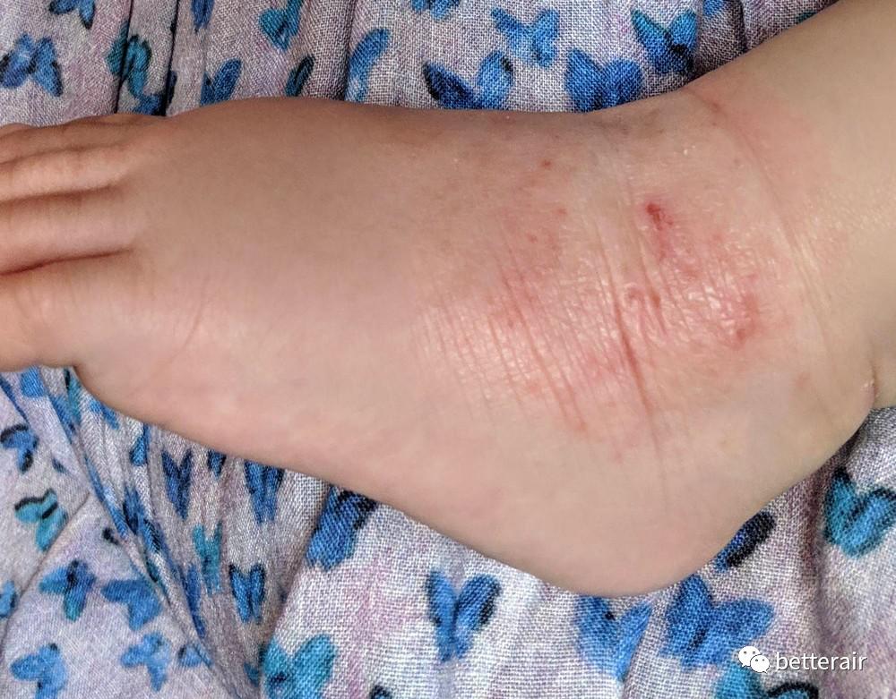 宝宝湿疹好了后一哭就变红,宝宝湿疹怕冷还是热