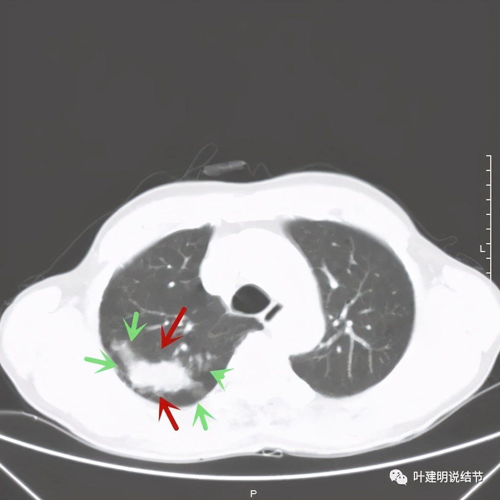 肺占位病理活检无病变,肺部占位穿刺病理说不确定性质