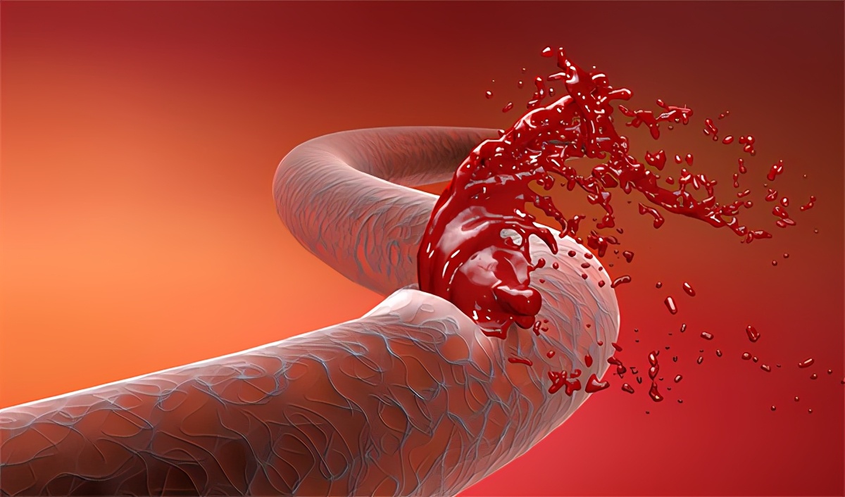 痔疮出血怎么办?一洗二躺三用药,少了哪个都不行
