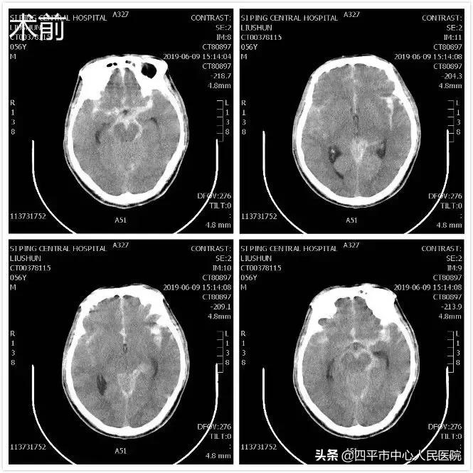 精准排雷再现新高—神经外科在6月份成功救治6例颅内动脉瘤患者