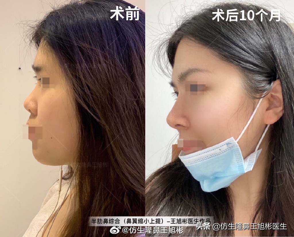 那些被鼻子“封印”颜值的鼻综合/修复案例|广州鼻整形