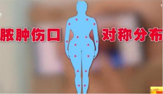 女子面部整形后差点丧命,女子做了一个可怕的整形手术