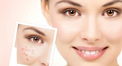 怎样有效消除脸上的痘痘,怎样去除脸上的痘痘和痘印