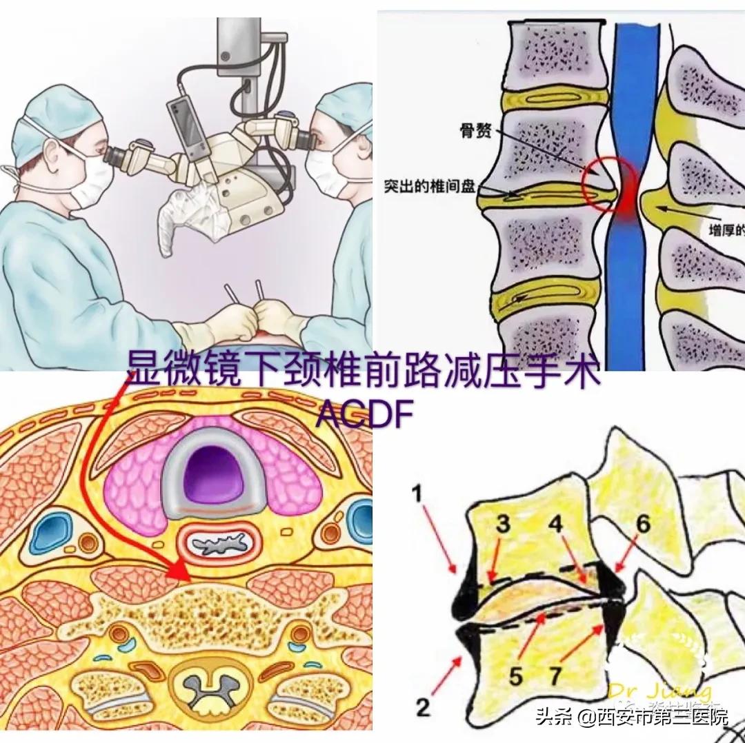 颈椎病减压手术安全么,手术脊髓减压