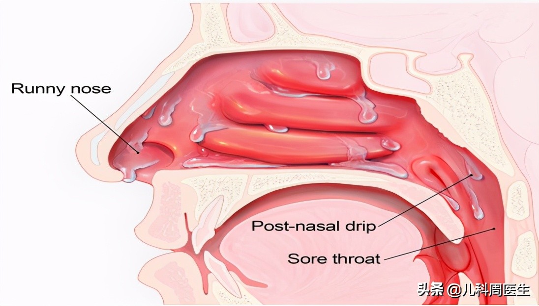 黄鼻涕与清鼻涕有什么关系,透明鼻涕和清鼻涕有什么区别