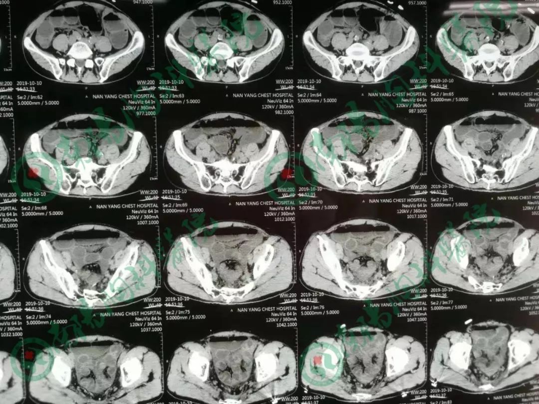 南阳胸科医院治疗直肠癌患者病例
