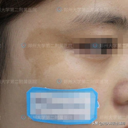 脸上有斑是做冷冻还是激光,黄褐斑用激光祛好还是吃中药