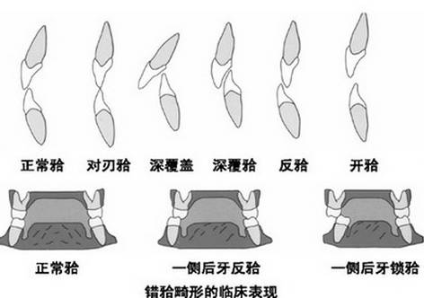 牙科隐形矫正科普,helen齿科