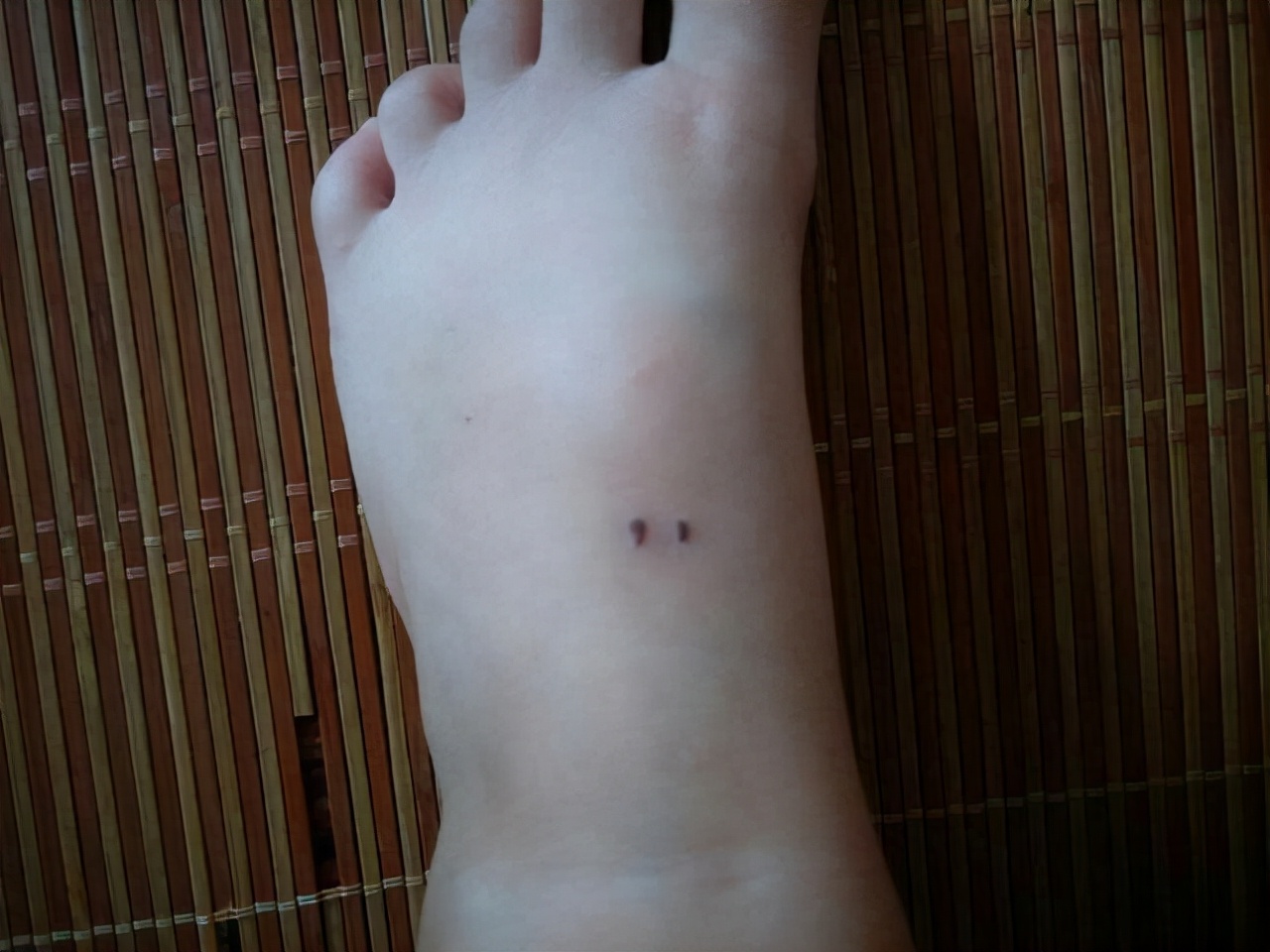 2块钱一支的红霉素软膏3个功效,红霉素软膏几块的和几十的区别