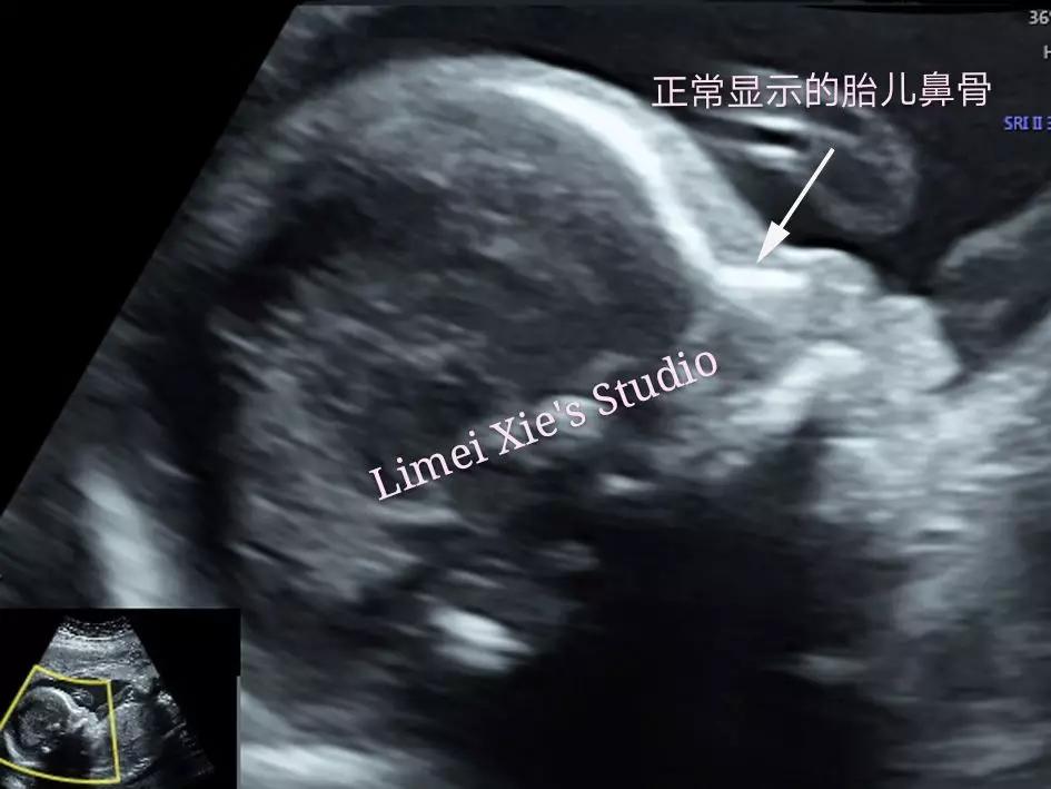 唐氏儿鼻骨是缺失还是发育不良,20周胎儿一侧鼻骨缺失或发育不良