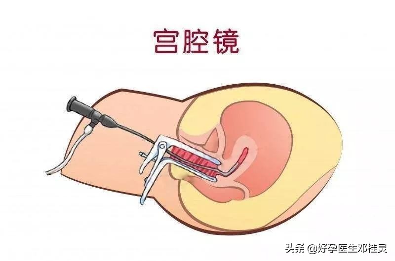 内膜厚刮宫好还是做宫腔镜手术好,子宫内膜不均医生建议宫腔镜