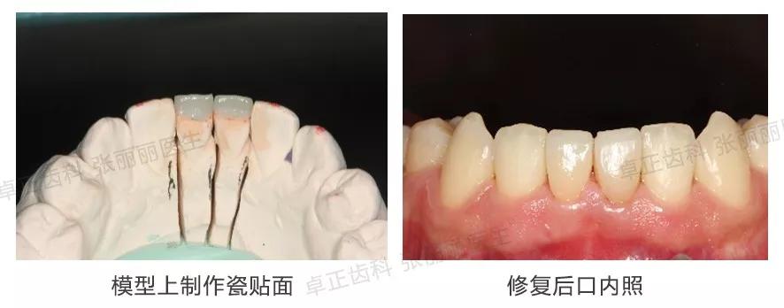 牙齿楔状缺损修复图片,牙齿楔状缺损修复大概多少钱