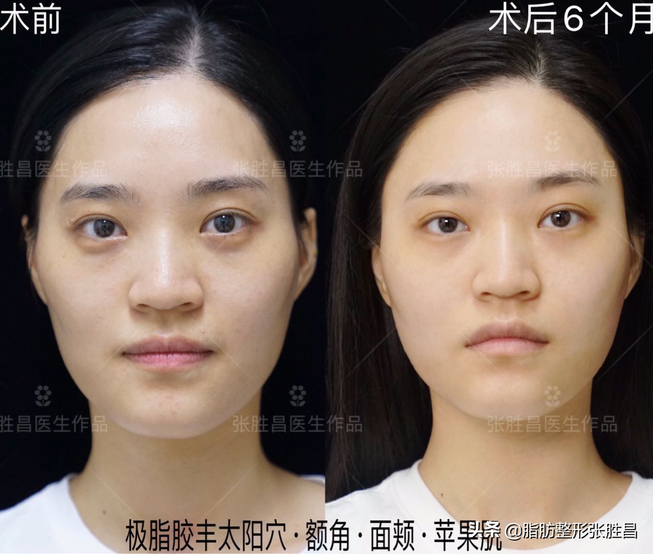 自体脂肪胶填充太阳穴泪沟法令纹,自体脂肪太阳穴填得太饱满了