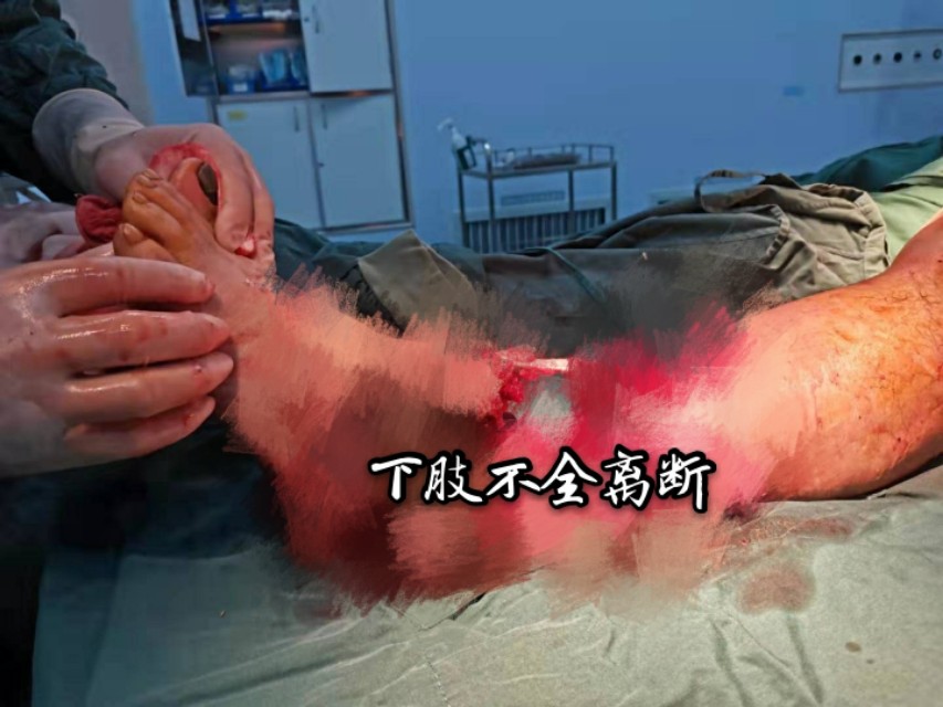 沈医附属中心医院7小时手术为他“留”左脚,这种危险身边还有!