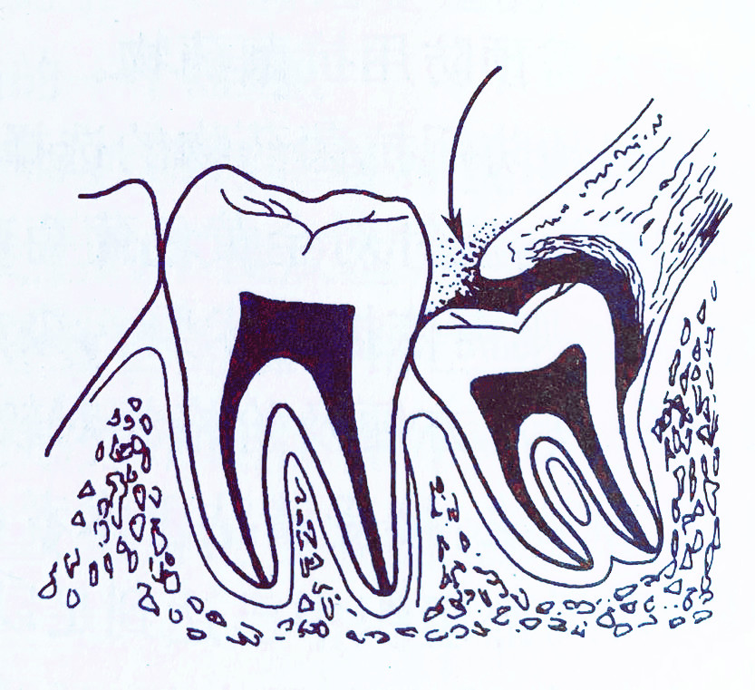 智齿发炎脸肿又感染新冠怎么办,急性智齿发炎脸肿吃什么下火