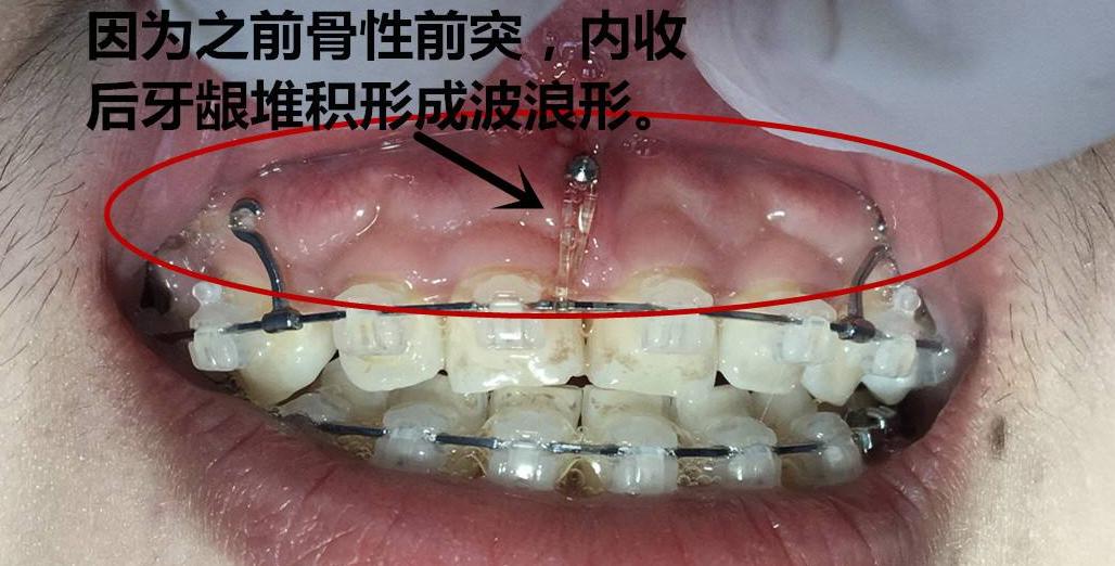 为什么有的人戴牙套要拔牙,为什么有的人戴牙套需要打钢钉