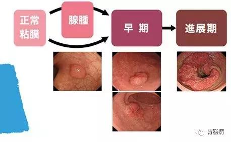 大肠息肉到大肠癌早期要多长时间,大肠息肉癌早期10大征兆