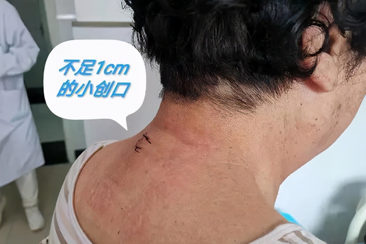 脊髓型颈椎病钥匙孔手术,和平医院微创