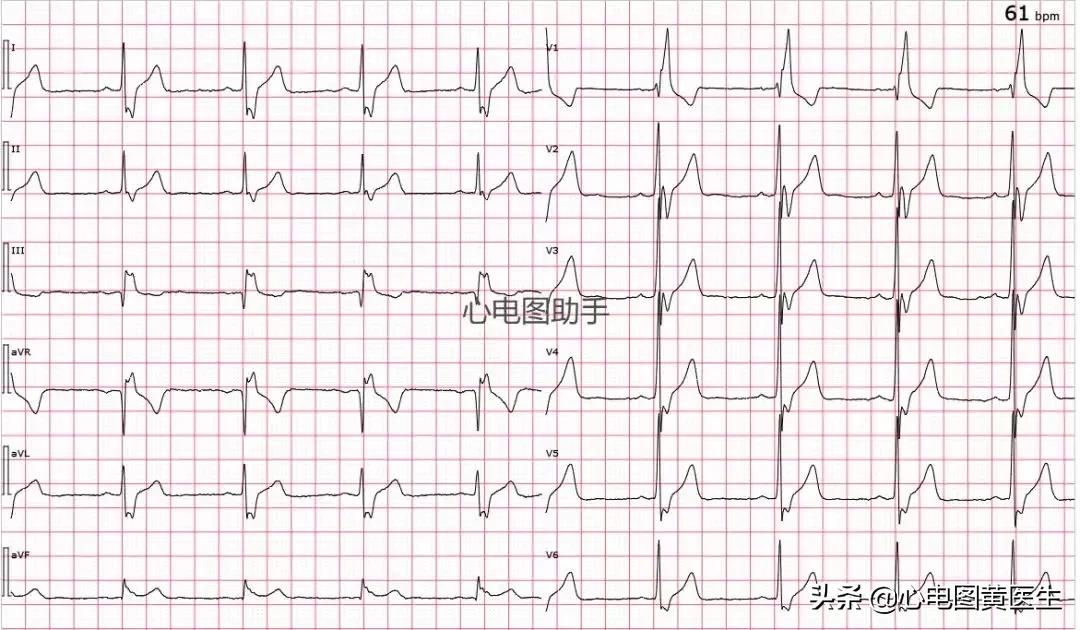 完全性右束支传导阻滞注意什么,完全性右束支传导阻滞如何解决