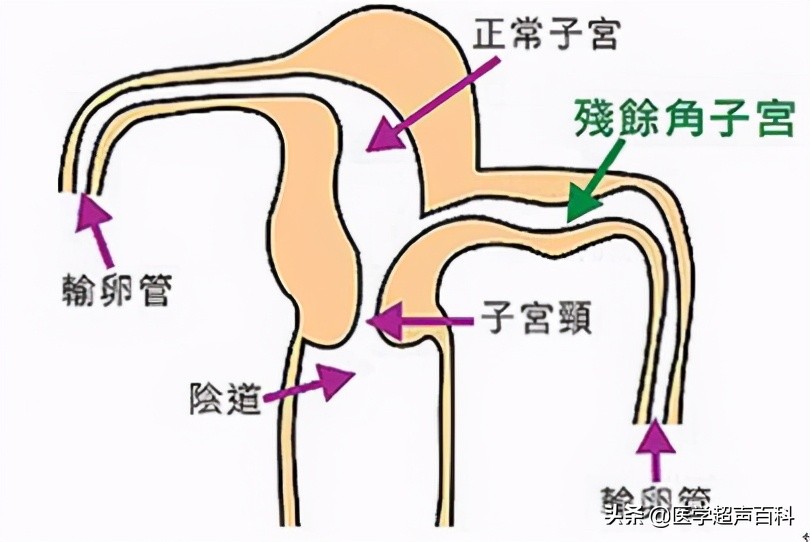 子宫发育异常能怀孕吗,幼稚子宫和子宫发育不良的区别