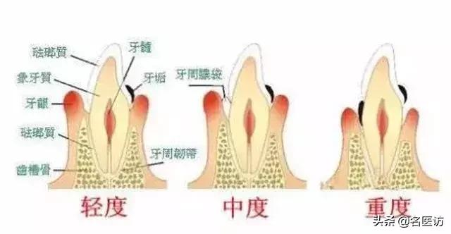 牙龈萎缩是什么原因引起的,牙龈萎缩专用药