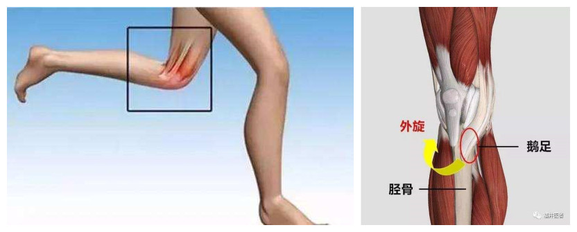 膝关节鹅足,有一种膝关节痛叫鹅足发炎