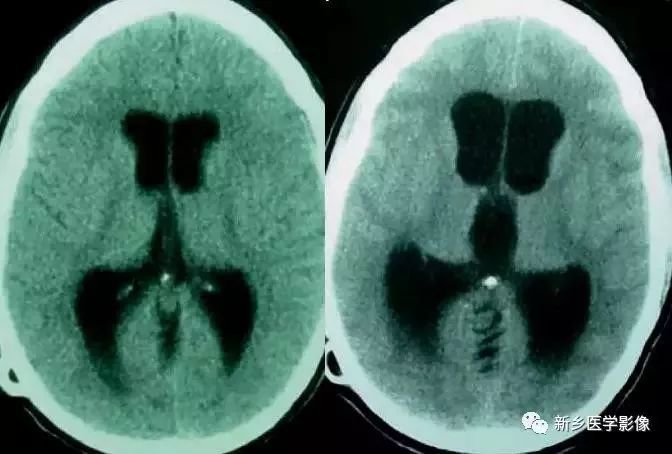 影像学脑室扩大,脑室显大怎么理解