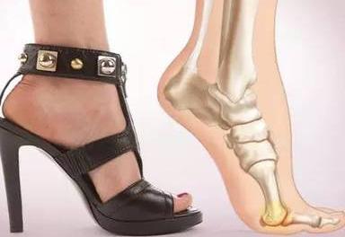 拇趾外翻的克星,拇外翻怎么矫正女孩