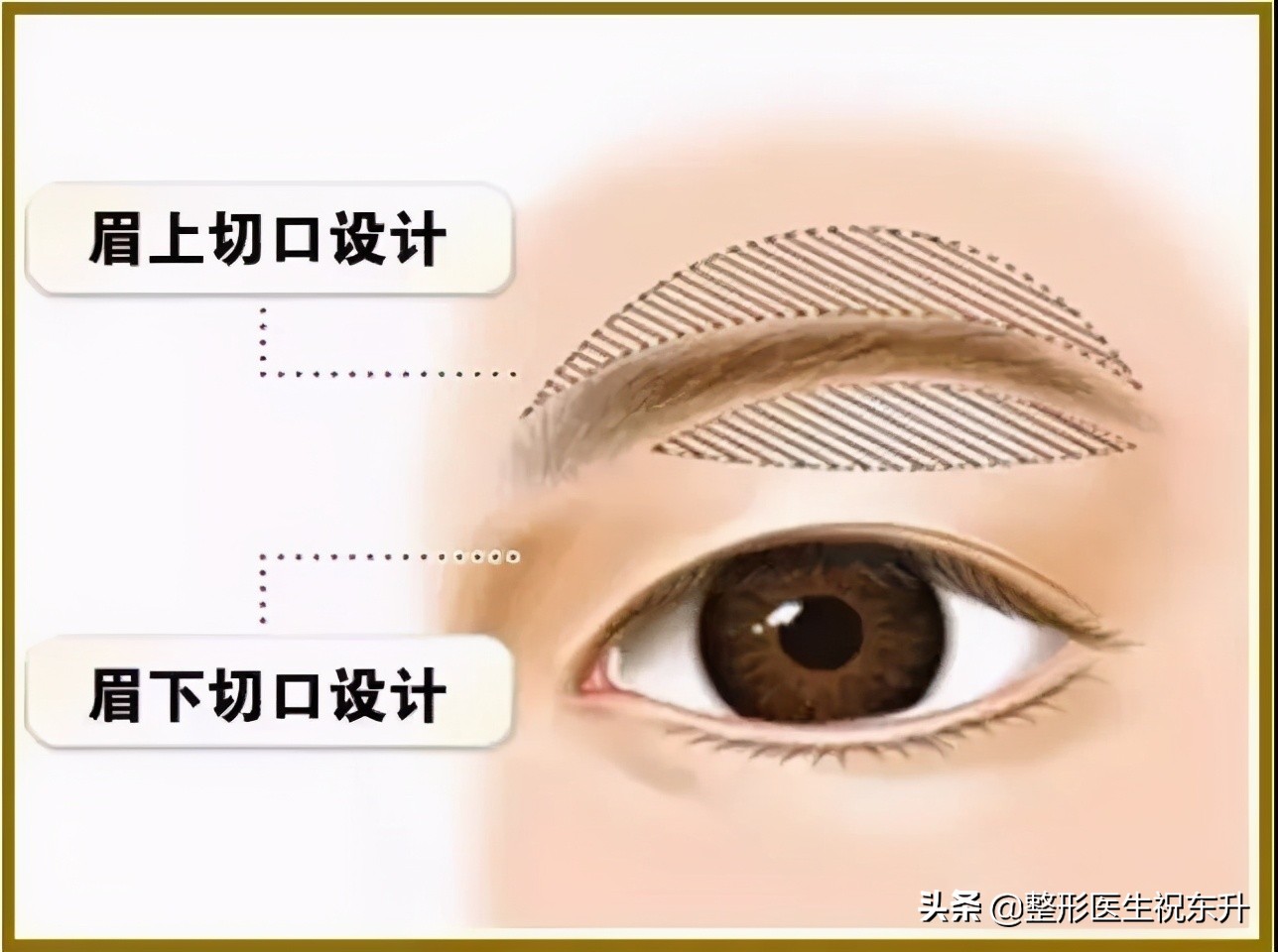 提眉手术害怕不害怕,做提眉手术有什么风险