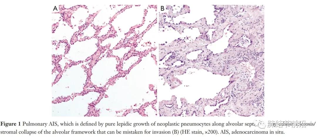 早期肺腺癌分哪几种,微浸润肺腺癌病理为什么没有分型