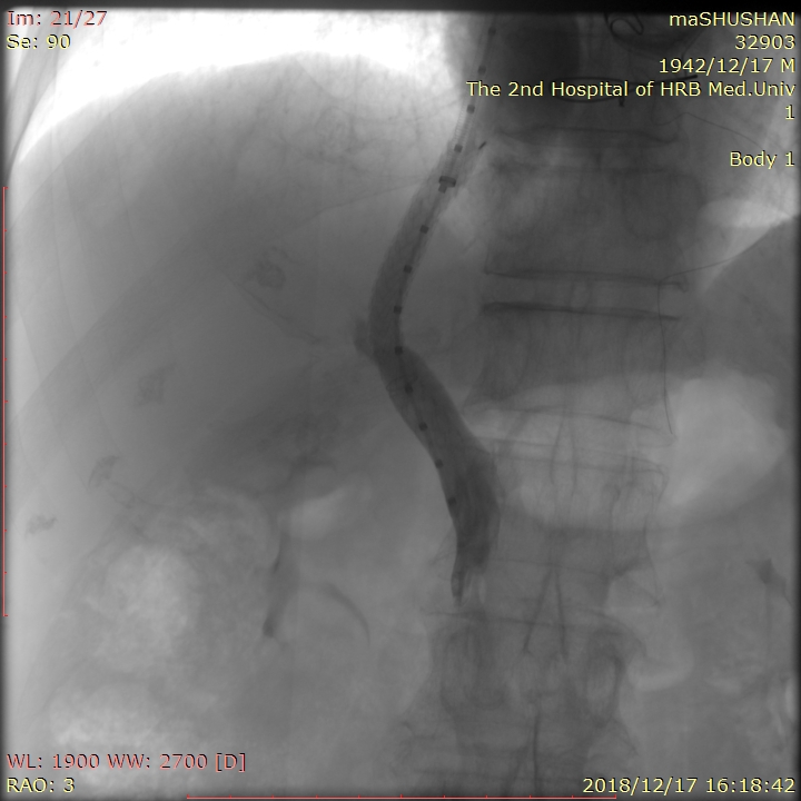 哈医大二院介入科专家,哈医大二院治肝权威教授