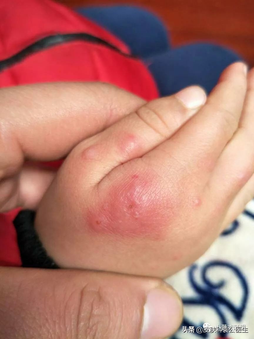 冻伤后痒痒是怎么回事,冻伤瘙痒