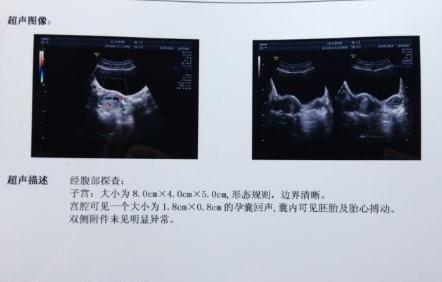 怀孕25天左右b超能看到孕囊吗,怀孕50天的孕囊视频