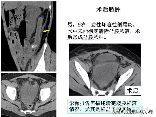 阑尾炎课件,阑尾炎的超声课件