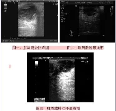 肛周脓肿误诊直肠癌,肛周脓肿误诊成内痔