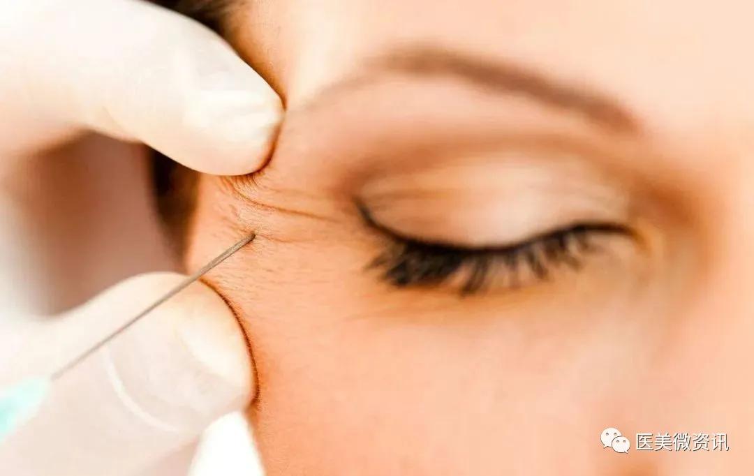 眼周除皱的最佳方法,眼周祛皱术后效果对比