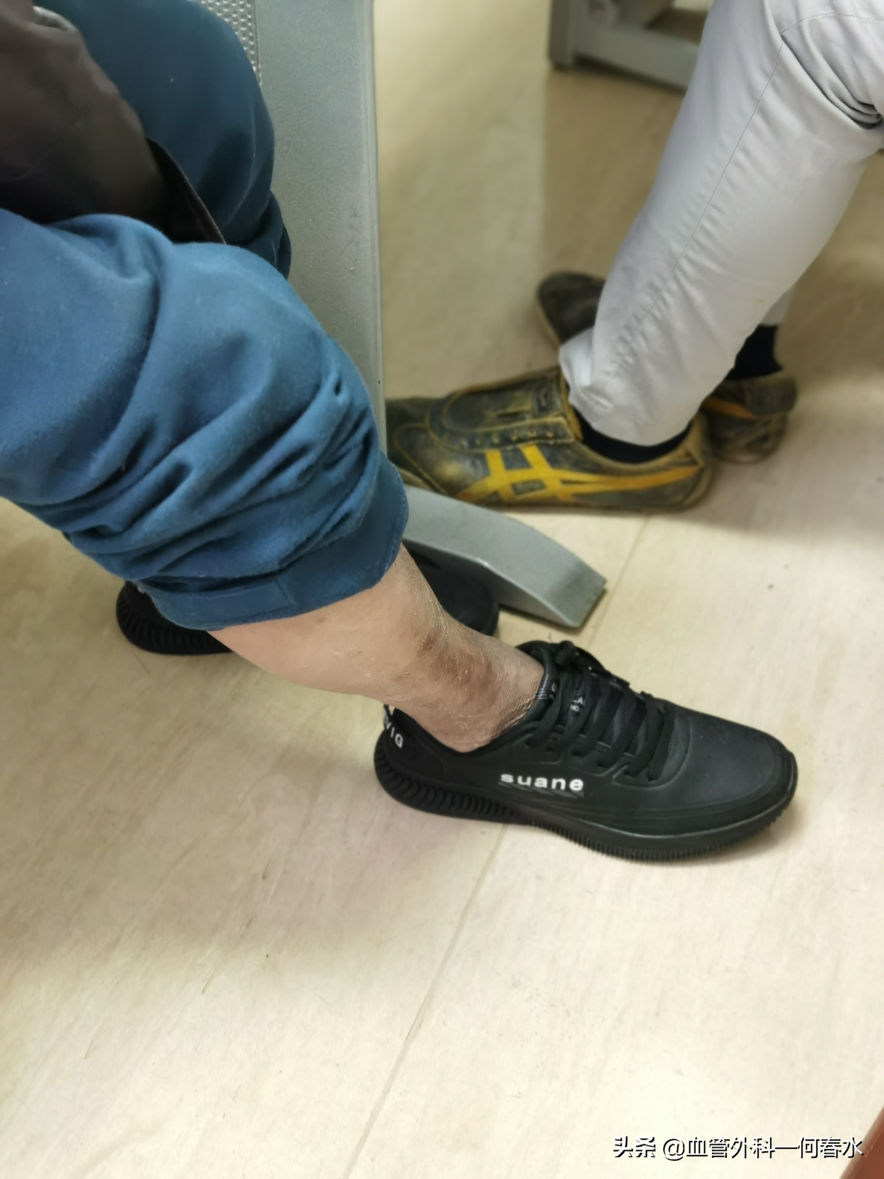 下肢动脉长斑块了，怎么才算严重？