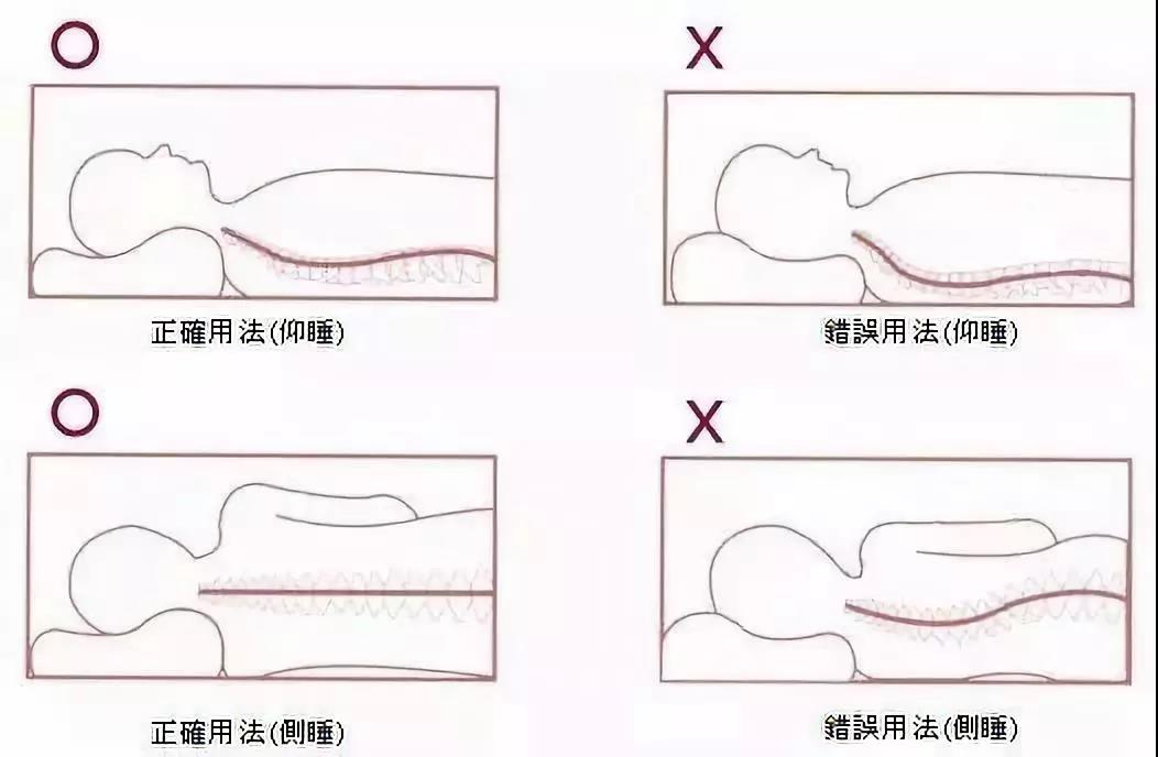 脖子后面鼓个小包怎么回事,颈椎病后面脖子有硬块