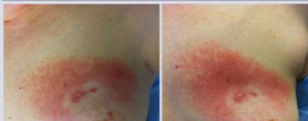 一表总览！迄今为止最全的肿瘤质子治疗适应症盘点！（收藏备用）