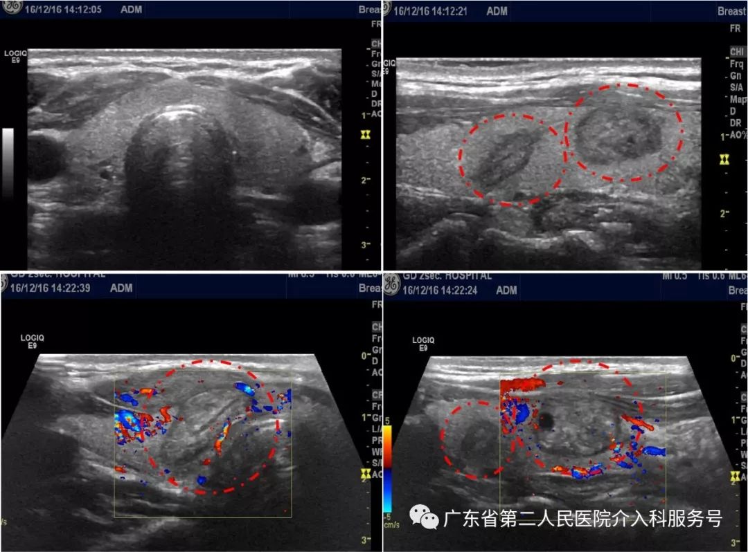 甲状腺结节观察与药物治疗2年能否缩小？微创消融治疗3年后如何？