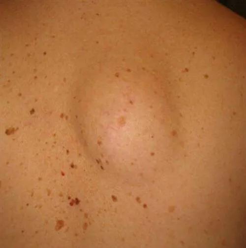 乙肝患者皮肤发黄还意味着什么,乙肝患者皮肤出现红点