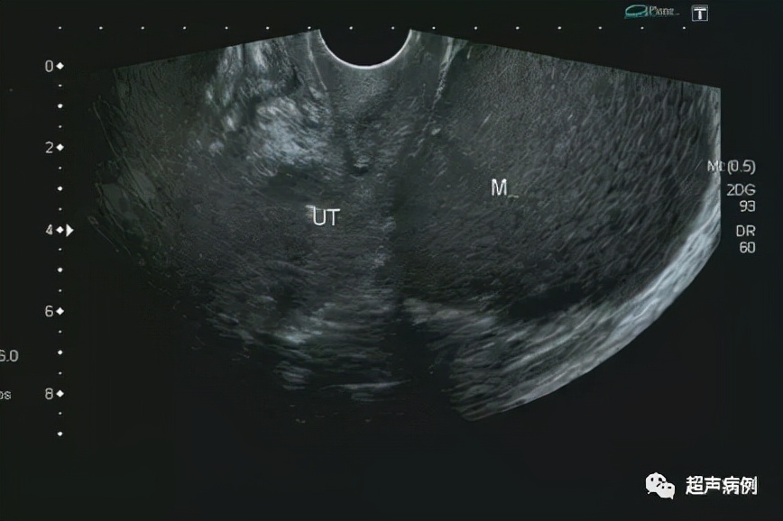 臀部包块超声检查,盆腔囊性包块10公分肚子剧痛
