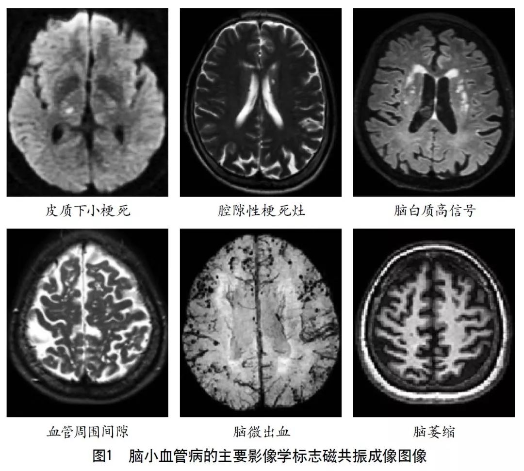 脑血管病影像诊断大全汇总,脑小血管病变影像学表现
