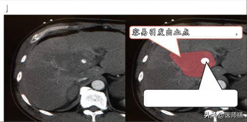 肝囊肿穿刺和微创切除哪个风险大,肝脏穿刺风险和后遗症