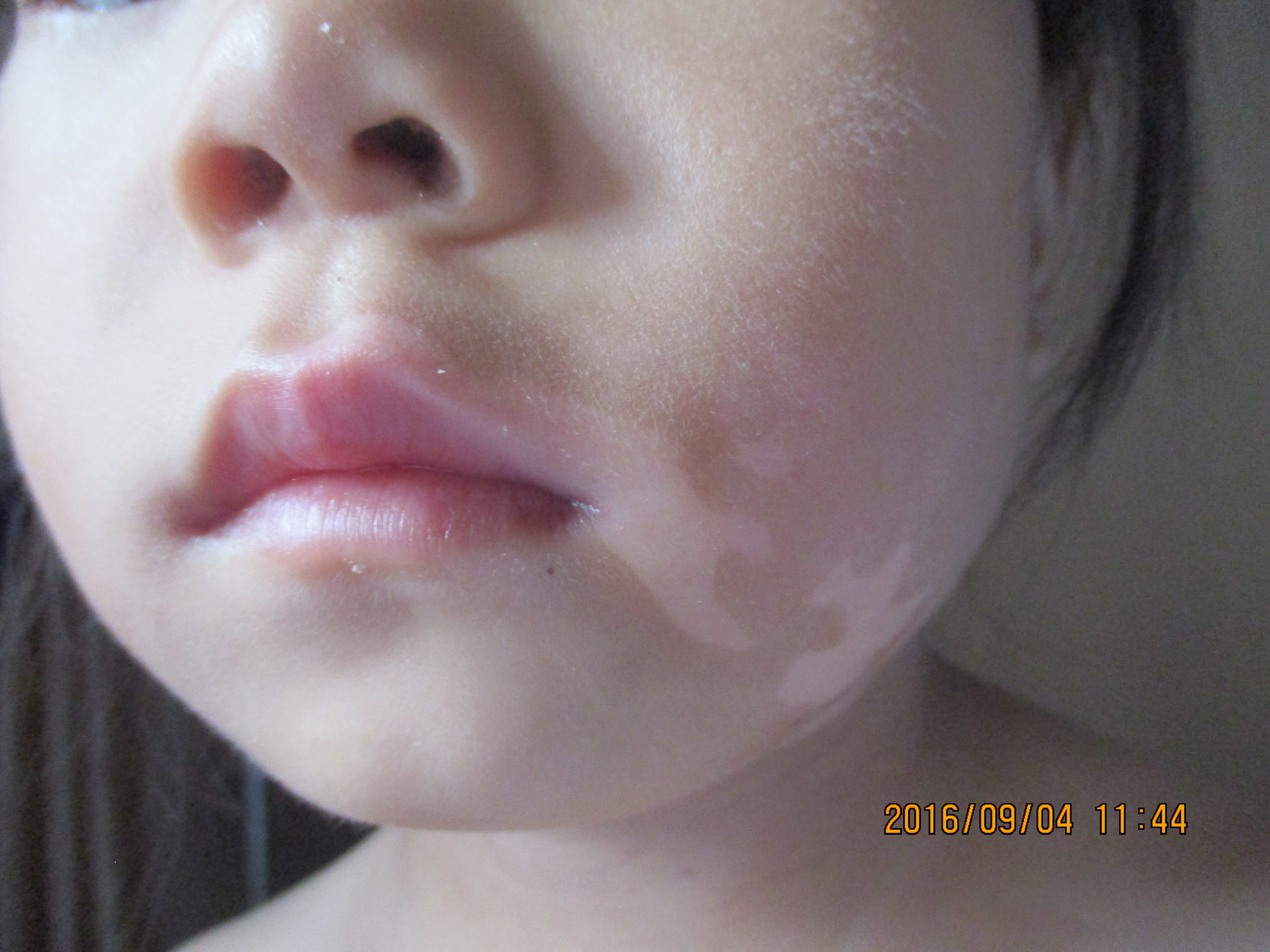 小孩脸上长白斑点什么问题,小孩脸上长白斑吃什么打虫药