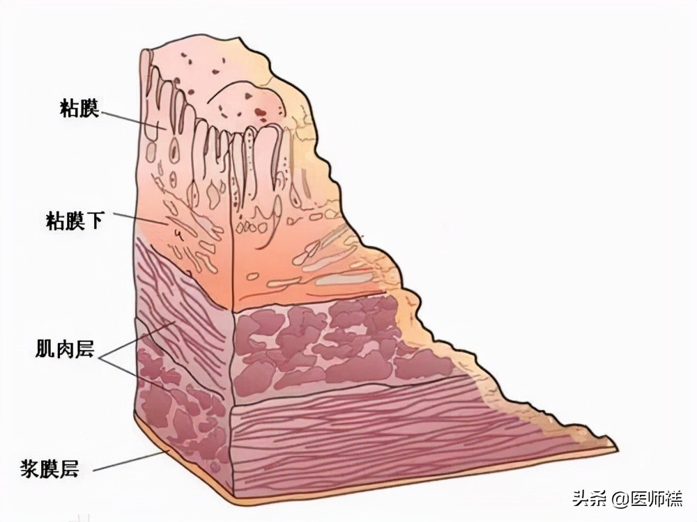 胃炎迁延不愈,胃炎久治不愈需要再做胃镜吗