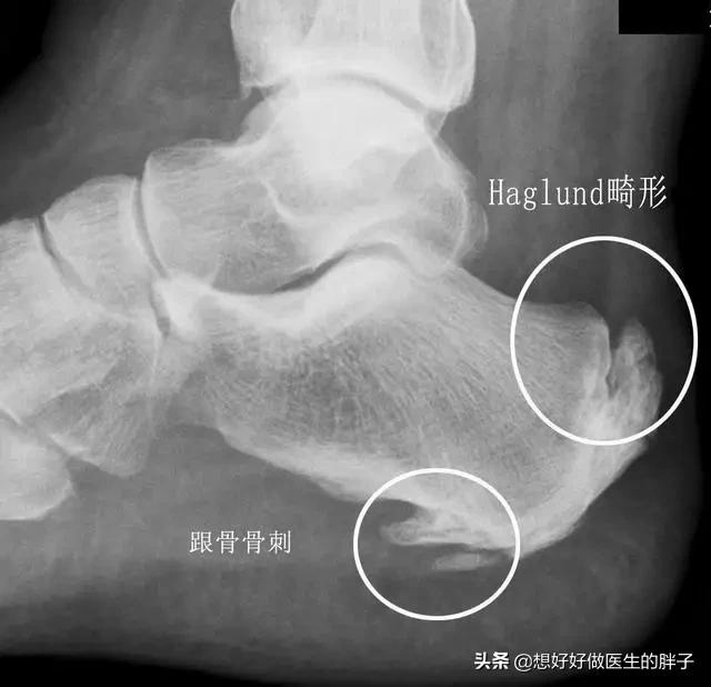 骨刺吃什么药可以抑制骨刺的生长,长骨刺独家药方喝四天就能止痛