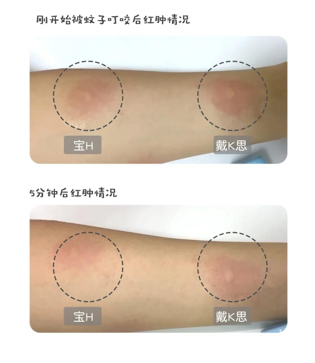 人肉实测第3弹！16款婴幼儿止痒产品只有1款5分钟见效